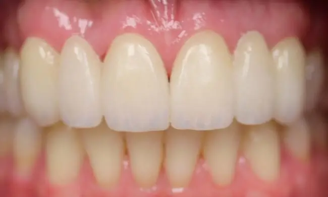 After - Smile makeover before and after - case 1