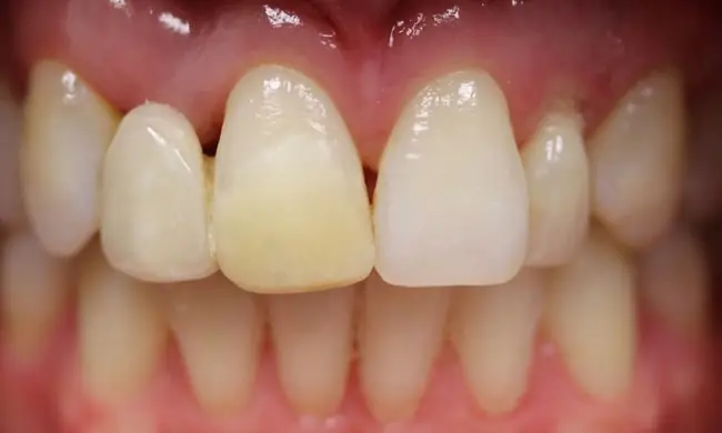 Before - Smile makeover before and after - case 1